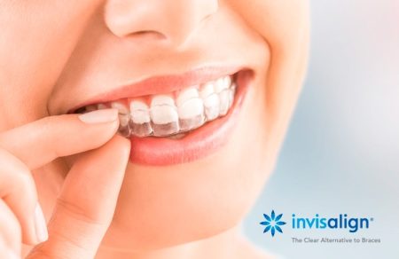 o-que-e-invisalign-1